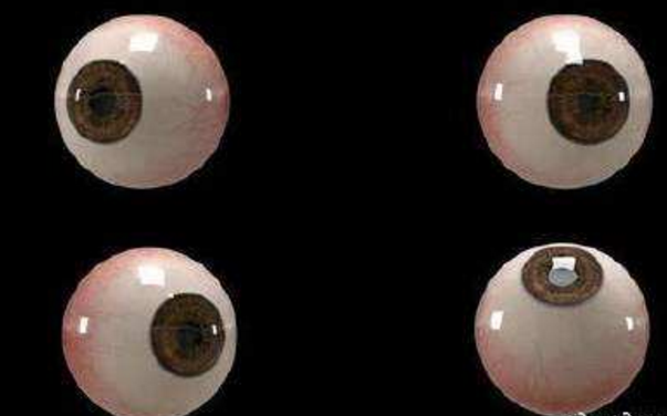 世界首個(gè)3D人工眼球問(wèn)世，數百萬(wàn)人將重見(jiàn)光明